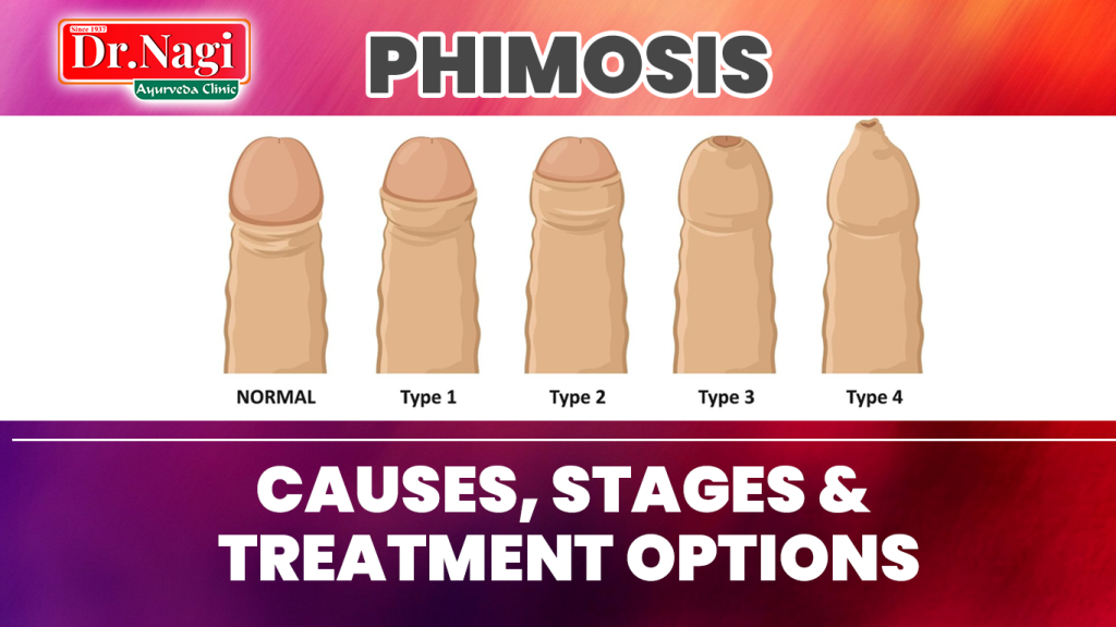 Phimosis