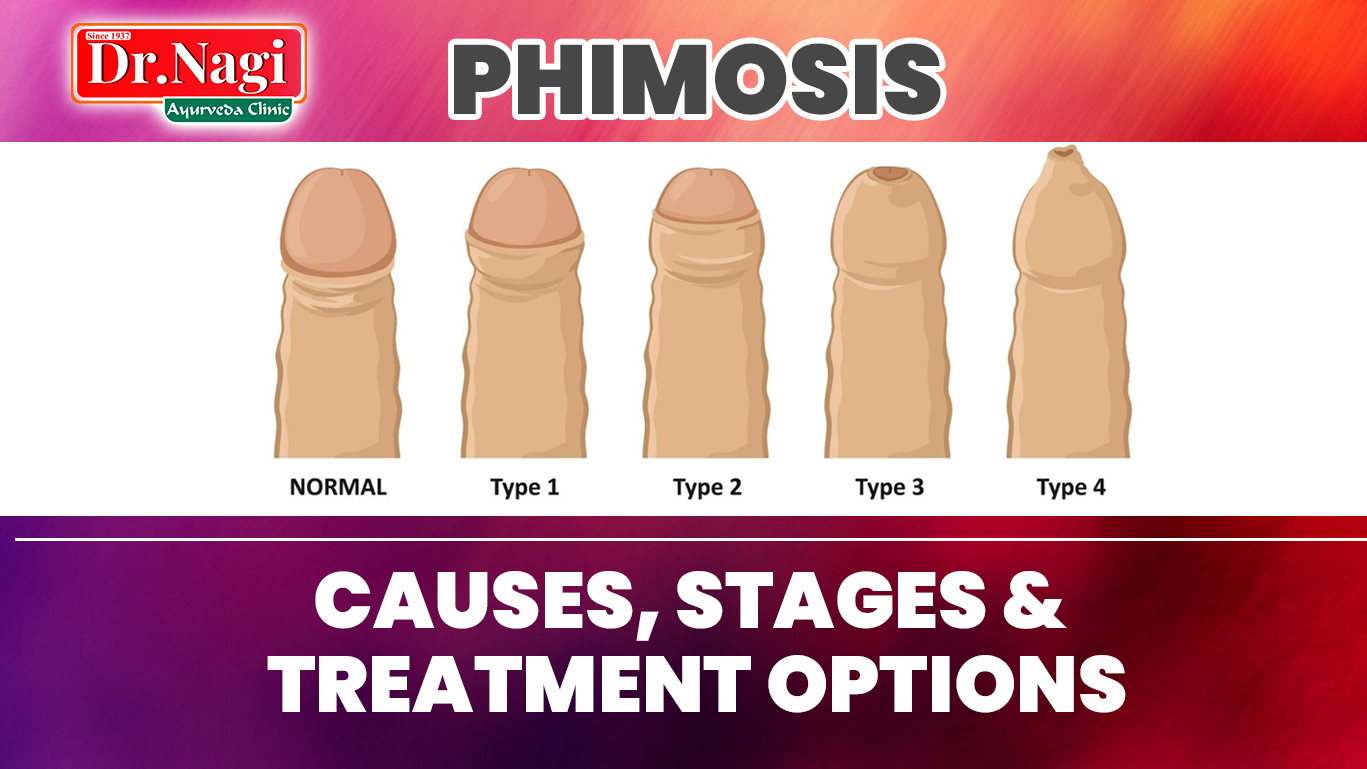 Phimosis: Causes, Stages & Treatment Options