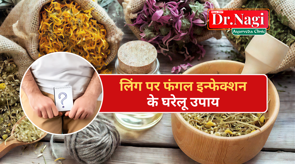 Ling par fungal infection ke gharelu upay