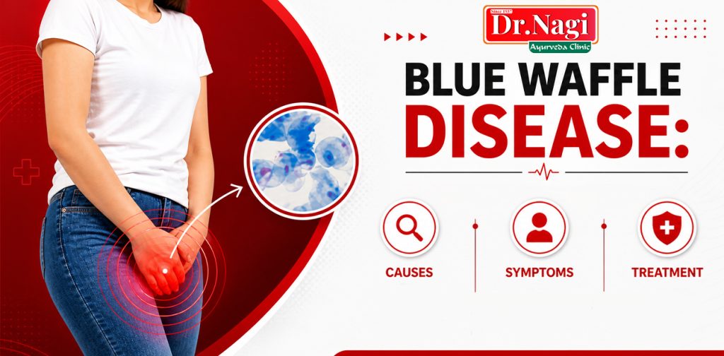 Blue Waffle Disease: Causes, Symptoms, and Treatment