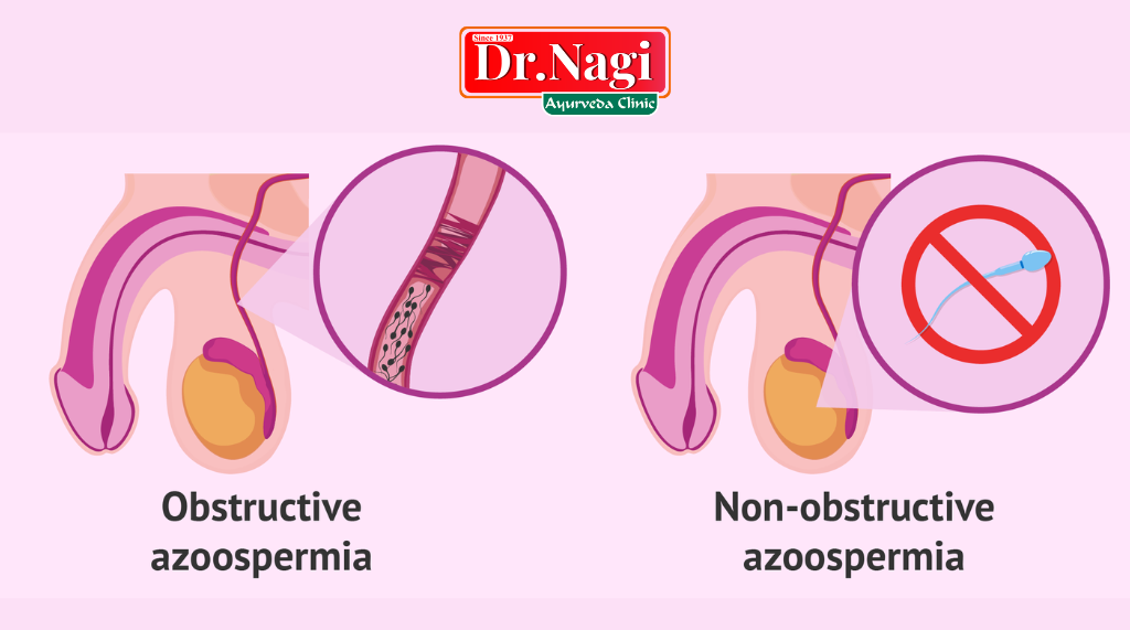 Types of Azoospermia